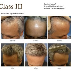 Meshkin Medical - Class 3,2500 grafts