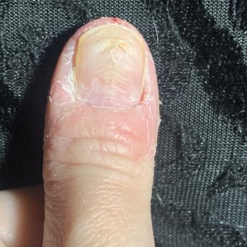 Phoenix Nails - Left thumb is still damaged - Nail Salons Near Me - Gaithersburg, Maryland Phoenix Nails - Left thumb is still damaged - Nail Salons Near Me - Gaithersburg, Maryland