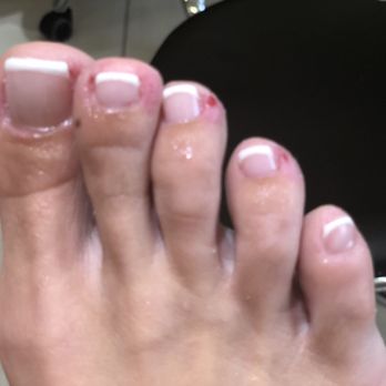 Amity Nail Spa - Wounds after disinfection. Bleeding - Nail Salons Near Me - Arlington, Virginia