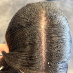 Glamourax - Dandruff, dry itchy scalp before