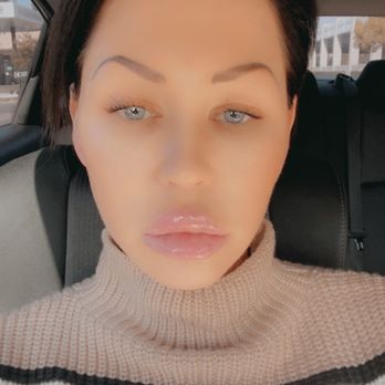 Cloud 9 Medi Spa - Cheek contour ! - Medical Spas Near Me - Yucaipa, California