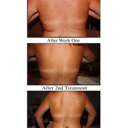 Skinny by Gwen, LLC - Mesotherapy fat shrinking skin tightening treatment.