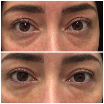 Sand Dermatology - Under eye filler treatment 1 week later. One syringe of Restylane. - Dermatologists Near Me - Chino Hills, California Sand Dermatology - Under eye filler treatment 1 week later. One syringe of Restylane. - Dermatologists Near Me - Chino Hills, California