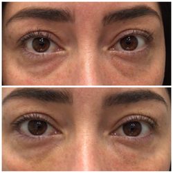 Under eye filler treatment 1 week later. One syringe of Restylane.