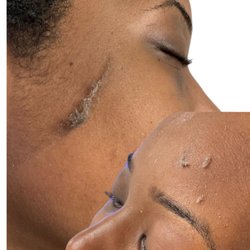 Skin Aesthetics - Dermaplane