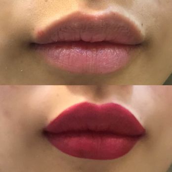 Aisthetikos - After Dr. Smith injected Juvederm, 1 month post procedure - Cosmetic Surgeons Near Me - Newport Beach, California Aisthetikos - After Dr. Smith injected Juvederm, 1 month post procedure - Cosmetic Surgeons Near Me - Newport Beach, California