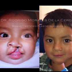 Dr. Rodrigo Morales de la Cerda - Cleft lip and palate reconstruction