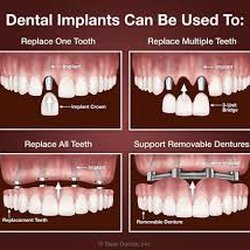 My Family Dental - Whether you need one implant or full mouth restoration.