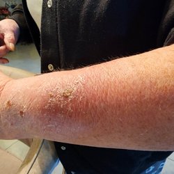 Suncoast Urgent Care- Spring Hill - Celluitis