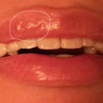 LaserAway - you can see the bump from the needle sites when I smile. this is taken in lowlight. - Tattoo Removal Near Me - Seattle, Washington LaserAway - you can see the bump from the needle sites when I smile. this is taken in lowlight. - Tattoo Removal Near Me - Seattle, Washington