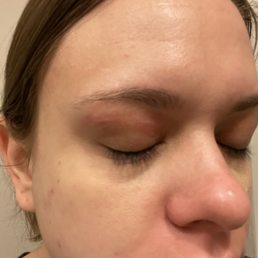 Swollen red and painful to touch day 1