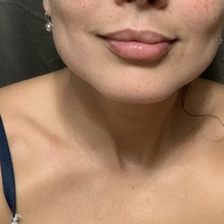 The Tox Lady - After 1 syringe Versa (8 hrs later)