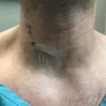 Albert P Wong, MD - Day after surgery at surgical center . - Spine Surgeons Near Me - Los Angeles, California