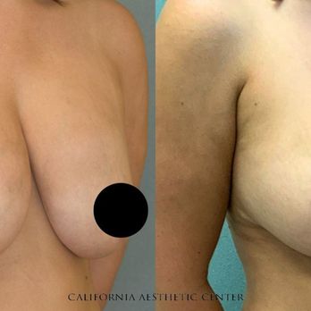Steve T. Vu MD, FACS - Mastopexy (Breast Lift) + Removal & Replacement of Breast Implants.
7 months post-procedure. - Cosmetic Surgeons Near Me - Corona, California Steve T. Vu MD, FACS - Mastopexy (Breast Lift) + Removal & Replacement of Breast Implants.
7 months post-procedure. - Cosmetic Surgeons Near Me - Corona, California