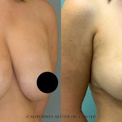 Steve T. Vu MD, FACS - Mastopexy (Breast Lift) + Removal & Replacement of Breast Implants. 
7 months post-procedure.