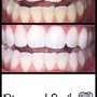 Diamond Smile Whitening