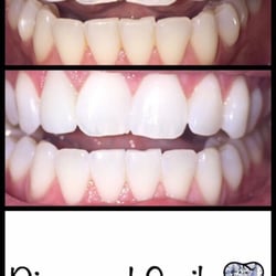 Diamond Smile Whitening