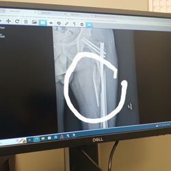 Huntsville Hospital - How dr robert allen maples left my leg
