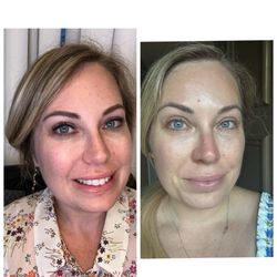 (Before and after) You won't regret the amazing FACIALS here!