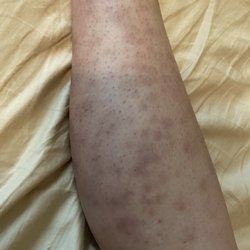Rejuv Laser Spa - Reaction to laser