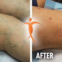Empire Vein and Vascular Specialists - Real Patient Before and After