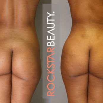 Rockstar Beauty - Brazilian Butt Lift with Fat Transfer - Medical Spas Near Me - Beverly Hills, California Rockstar Beauty - Brazilian Butt Lift with Fat Transfer - Medical Spas Near Me - Beverly Hills, California