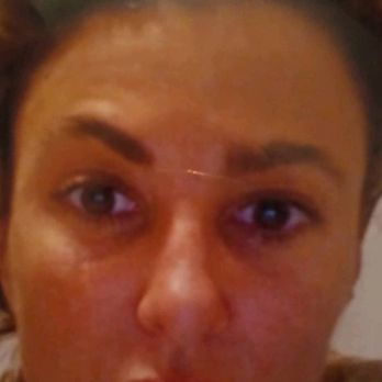 Behrooz Torkian Facial Plastic Surgery - This isnt painful. in an altered mental state, I cant get help.  All that tissue physically cooked off. Brain is literally on fire. - Cosmetic Surgeons Near Me - Beverly Hills, California