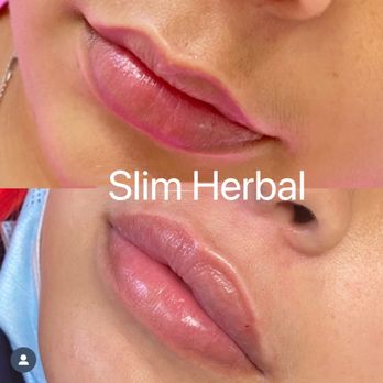Slim Herbal - Filler for lip - Skin Care Near Me - Flushing, New York Slim Herbal - Filler for lip - Skin Care Near Me - Flushing, New York