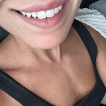 Mint Dental - Had my brackets taken off today... 1 year of Invisalign and beyond happy with the results! - Cosmetic Dentists Near Me - Laguna Niguel, California Mint Dental - Had my brackets taken off today... 1 year of Invisalign and beyond happy with the results! - Cosmetic Dentists Near Me - Laguna Niguel, California