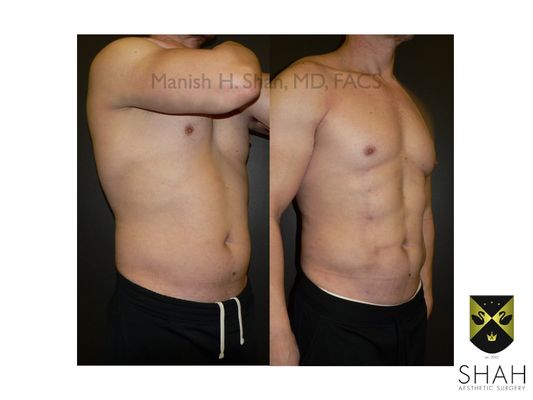 Shah Aesthetic Surgery - Rhinoplasty and Facelift Specialist by null