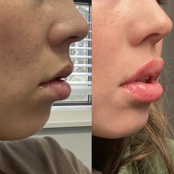 Pure Med Spa - Before and immediately after 1 cc lip filler - Medical Spas Near Me - Chicago, Illinois
