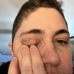 Jude's Barbershop Comstock Park - Injured left eyelid.