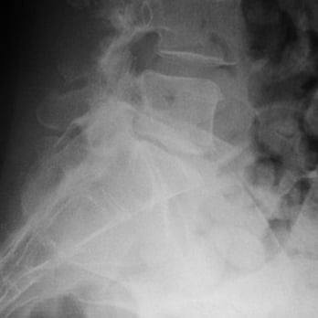 Yuri Falkinstein, MD - Before Dr. Falkinstein: A portrait of pain. Note how vertebra L-5 is out of alignment and has little disc space above and below. - Orthopedists Near Me - Burbank, California Yuri Falkinstein, MD - Before Dr. Falkinstein: A portrait of pain. Note how vertebra L-5 is out of alignment and has little disc space above and below. - Orthopedists Near Me - Burbank, California