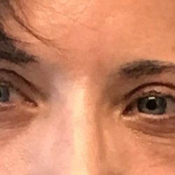 Valley Ophthalmic Facial Plastic Surgery - No makeup after eye procedure