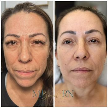 Sculpt AZ - 3 Sessions of Exion - Medical Spas Near Me - Phoenix, Arizona