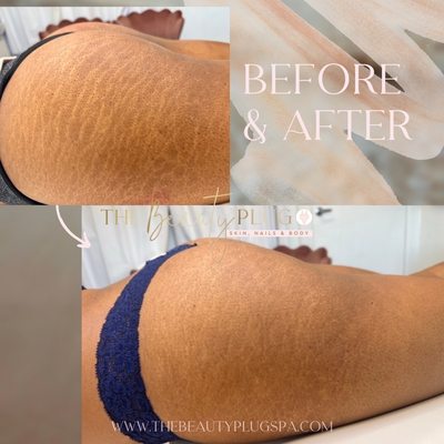 Stretch Mark & Scar Camouflage - Before and afters of our stretch mark camouflage, giving you your confidence back Stretch Mark & Scar Camouflage - Before and afters of our stretch mark camouflage, giving you your confidence back