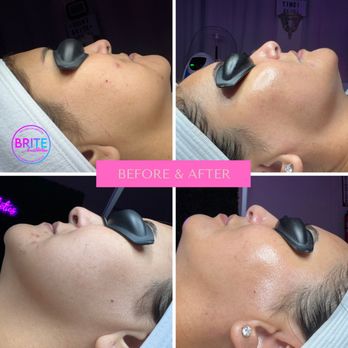 Brite Aesthetics - Skin Care Near Me - Corona, California