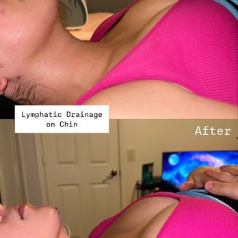 Arijes Beauty Studio - Post surgery lymphatic on chin - Body Contouring Near Me