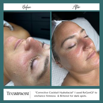 Cultivated Aesthetics - Before and After Hydrafacial treatment. - Skin Care Near Me - Oceanside, California Cultivated Aesthetics - Before and After Hydrafacial treatment. - Skin Care Near Me - Oceanside, California