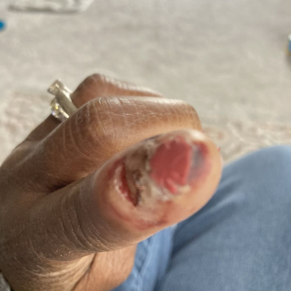 Gallery Nails - Infected index finger - Nail Salons Near Me - Raymore, Missouri Gallery Nails - Infected index finger - Nail Salons Near Me - Raymore, Missouri
