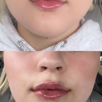 KLS Aesthetics - My immediate before and after; front facing. I am naturally an easy bruiser, so don't be alarmed! - Skin Care Near Me - Renton, Washington