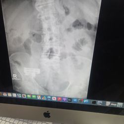 Greater Michigan Spine & Neurosurgery: Timothy Spencer, DO - L4 L5 DECOMPRESS
