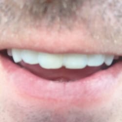 Mr. Dentist - Shoddy work. Lied about 12 month free touchups.
