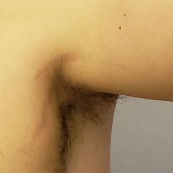 The Ferguson Clinic - Right underarm. Before first hair removal session - Cosmetic Surgeons Near Me - Honolulu, Hawaii The Ferguson Clinic - Right underarm. Before first hair removal session - Cosmetic Surgeons Near Me - Honolulu, Hawaii