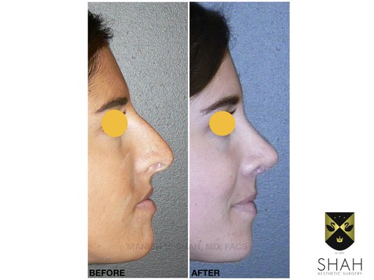 Shah Aesthetic Surgery - Rhinoplasty and Facelift Specialist by null