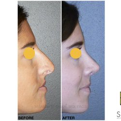 Shah Aesthetic Surgery - Rhinoplasty and Facelift Specialist - Ultrasonic Preservation Rhinoplasty Denver Dr. Shah