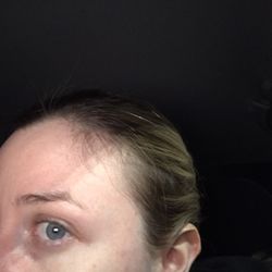 Self Image Salon - Side of my head is thinning and you can see the bald spot- courtesy of Self Image Salon.