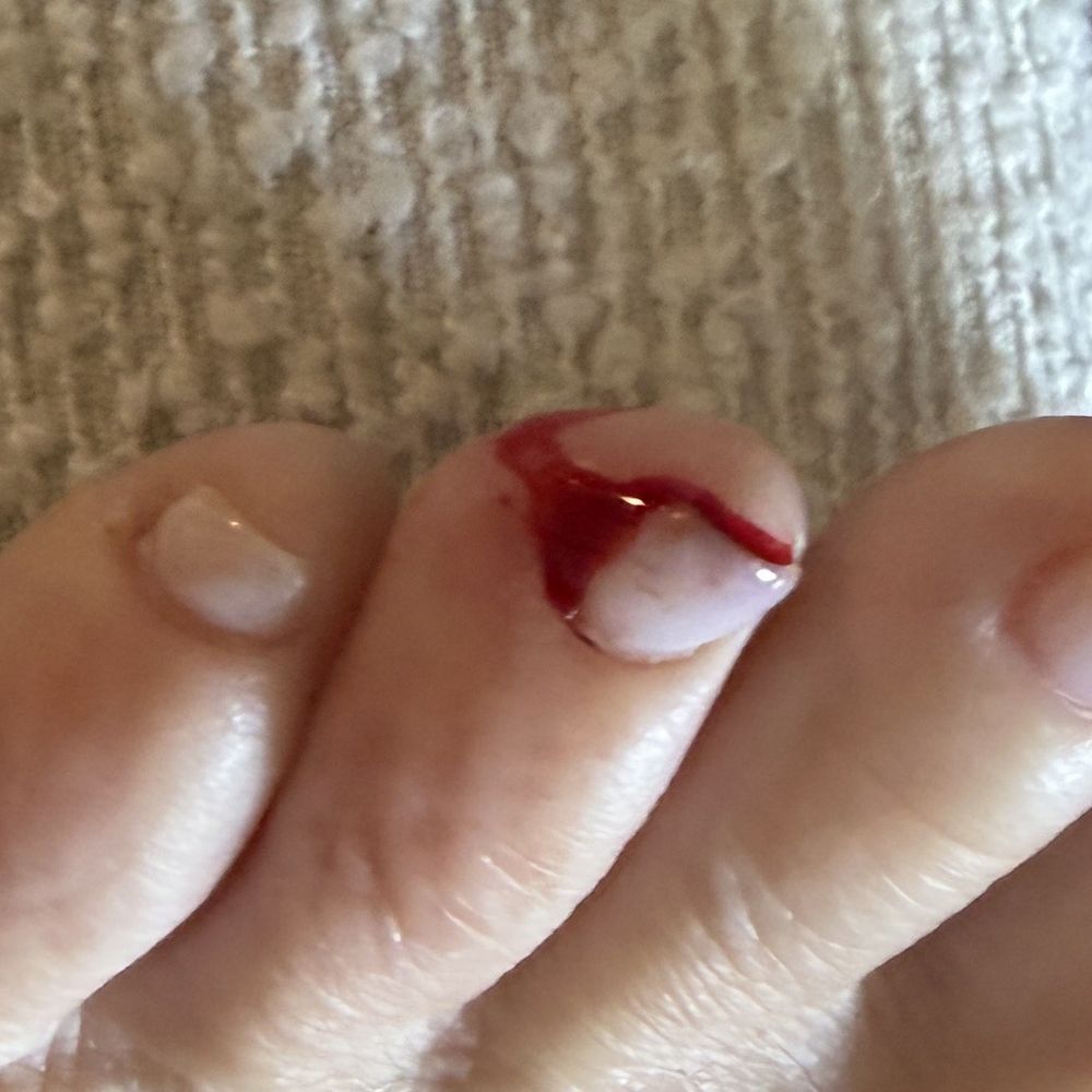 Flora Blanc Nail & Lash Studio - My toe 2 days after my pedicure. Still sore and started to bleed. - Nail Salons Near Me - Encinitas, California Flora Blanc Nail & Lash Studio - My toe 2 days after my pedicure. Still sore and started to bleed. - Nail Salons Near Me - Encinitas, California