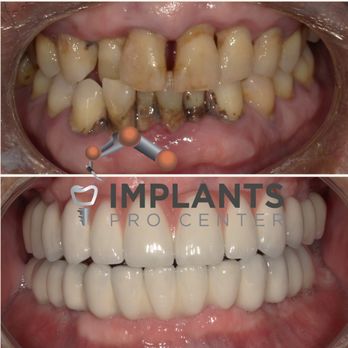 Implants Pro Center - Mohamed Ali, DDS - Transform your smile without invasive procedures. Our in-house lab offers full arch solutions without bone/gum reduction - Cosmetic Dentists Near Me - San Francisco, California Implants Pro Center - Mohamed Ali, DDS - Transform your smile without invasive procedures. Our in-house lab offers full arch solutions without bone/gum reduction - Cosmetic Dentists Near Me - San Francisco, California