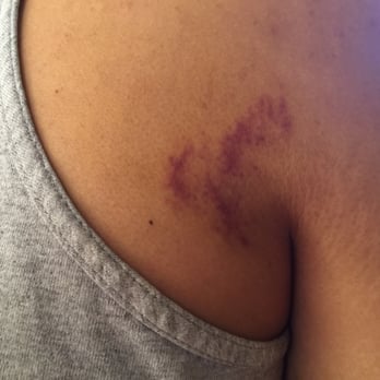 Venus  Spa - Masseur squeezed the crap out of me! This pic was taken A WEEK LATER after my wife noticed it. - Skin Care Near Me - Westminster, California